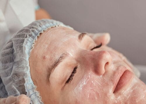 peeling químico